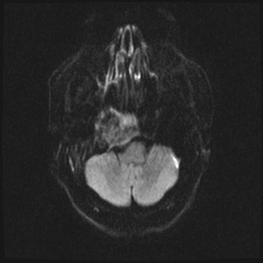 File:Cavernous sinus meningioma (Radiopaedia 63682-72367 DWI 25).jpg