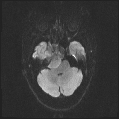 File:Cavernous sinus meningioma (Radiopaedia 63682-72367 DWI 47).jpg