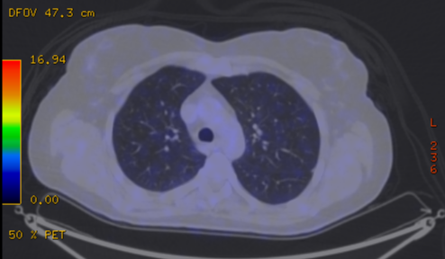 File:Cavitating lung mass - squamous cell carcinoma (Radiopaedia 48047-52853 A 33).png