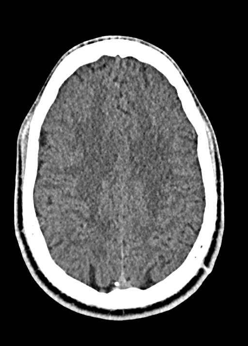 Cavum septum pellucidum and cavum vergae (Radiopaedia 77797-90060 Axial Brain Window 75).jpg