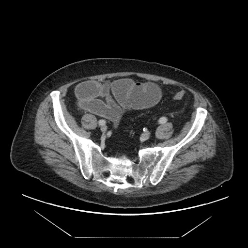 Cecal adenocarcinoma (Radiopaedia 64871-73817 A 74).jpg