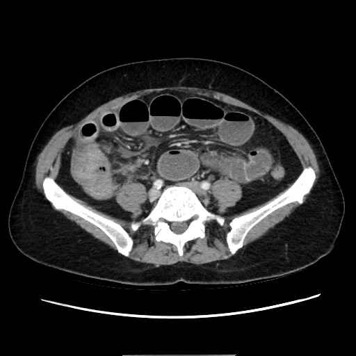 Cecal adenocarcinoma (Radiopaedia 75909-87331 A 59).jpg