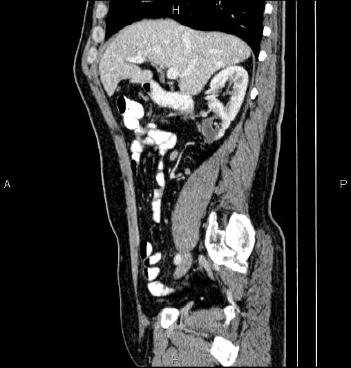 Cecal adenocarcinoma (Radiopaedia 85324-100916 E 31).jpg