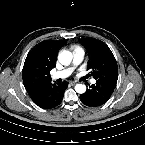 File:Cecal cancer with appendiceal mucocele (Radiopaedia 91080-108651 A 32).jpg