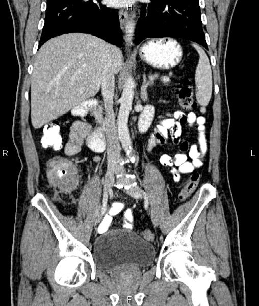 Cecal cancer with appendiceal mucocele (Radiopaedia 91080-108651 D 40).jpg