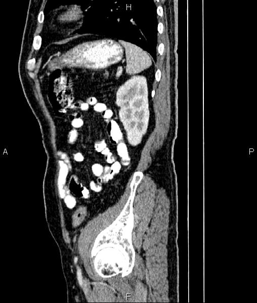 File:Cecal cancer with appendiceal mucocele (Radiopaedia 91080-108651 E 76).jpg