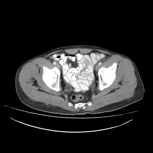 Cecal carcinoma with local lymphadenopathy (Radiopaedia 31428-32240 A 48).jpg