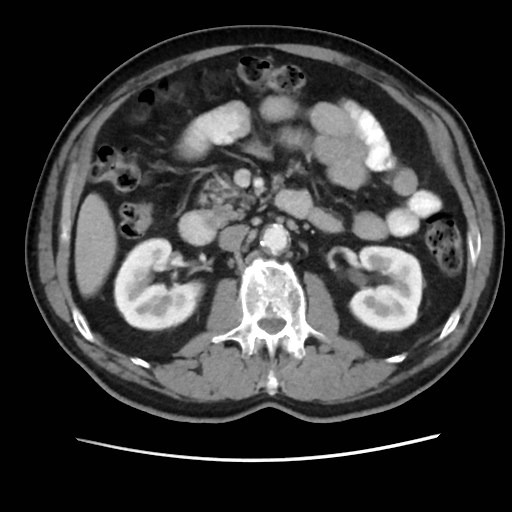 Cecal mass causing appendicitis (Radiopaedia 59207-66531 A 36).jpg