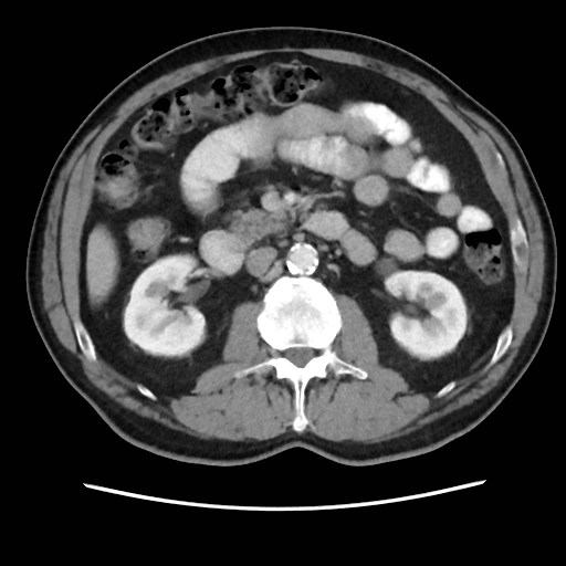 Cecal mass causing appendicitis (Radiopaedia 59207-66531 A 38).jpg
