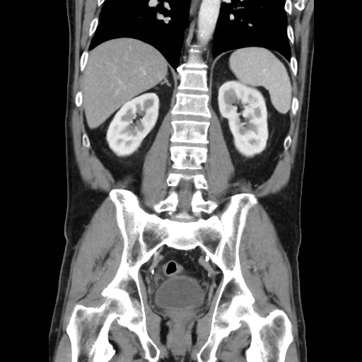 Cecal mass causing appendicitis (Radiopaedia 59207-66531 B 36).jpg