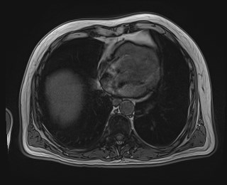 Cecal mass causing appendicitis (Radiopaedia 59207-66532 D 14).jpg