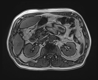 Cecal mass causing appendicitis (Radiopaedia 59207-66532 D 53).jpg
