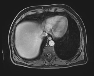 Cecal mass causing appendicitis (Radiopaedia 59207-66532 J 23).jpg