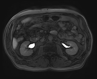 File:Cecal mass causing appendicitis (Radiopaedia 59207-66532 K 60).jpg
