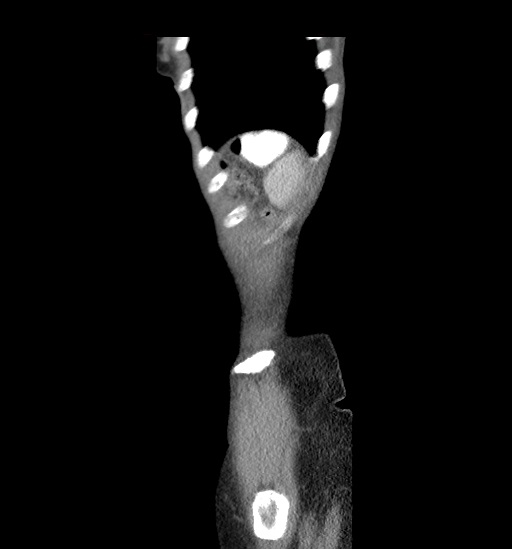 Cecal volvulus (Radiopaedia 48543-53513 C 49).jpg