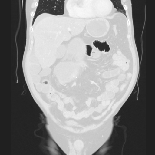 Cecal volvulus (Radiopaedia 75378-86620 Coronal lung window 57).jpg