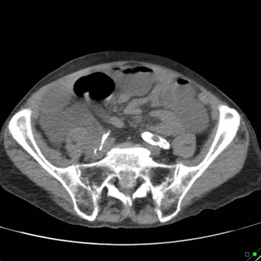 Cecal volvulus - atypical (Radiopaedia 21637-21588 non-contrast 51).jpg