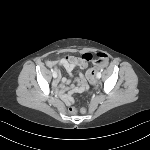 Cecum hernia through the foramen of Winslow (Radiopaedia 46634-51112 A 61).png