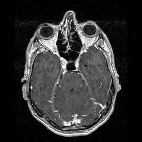 File:Central-variant posterior reversible encephalopathy syndrome (PRES) (Radiopaedia 43880-47358 Axial T1 C+ 45).jpg