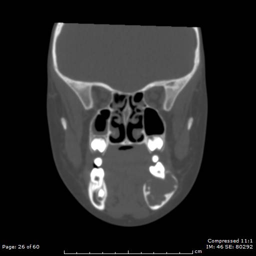 File:Central giant cell granuloma (Radiopaedia 45612-49754 Coronal bone window 26).jpg