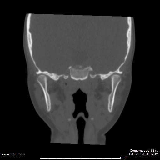 File:Central giant cell granuloma (Radiopaedia 45612-49754 Coronal bone window 59).jpg