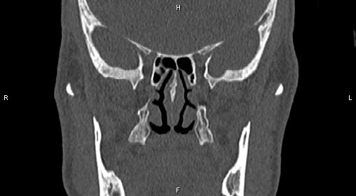 File:Central giant cell granuloma (Radiopaedia 83346-97761 Coronal bone window 20).jpg