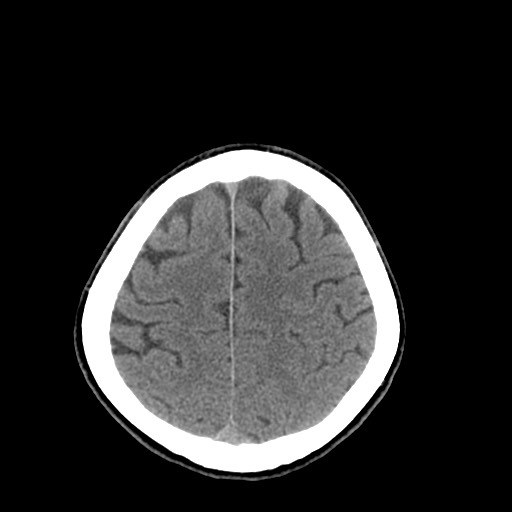 File:Central neurocytoma (Radiopaedia 68725-78432 Axial non-contrast 44).jpg