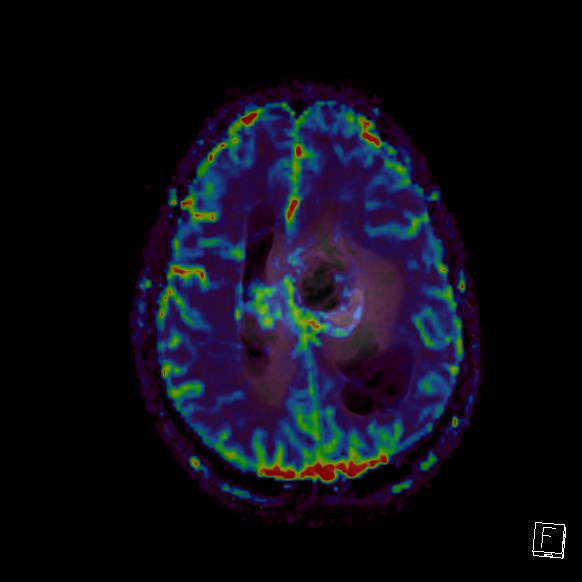 Central neurocytoma (Radiopaedia 84497-99872 Axial Perfusion 101).jpg