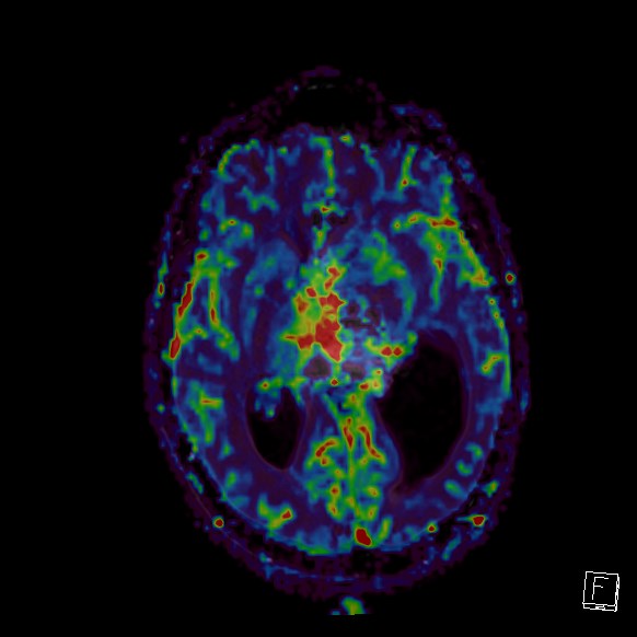 Central neurocytoma (Radiopaedia 84497-99872 Axial Perfusion 164).jpg