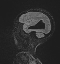 File:Central neurocytoma (Radiopaedia 84497-99872 Sagittal Flair + Gd 121).jpg