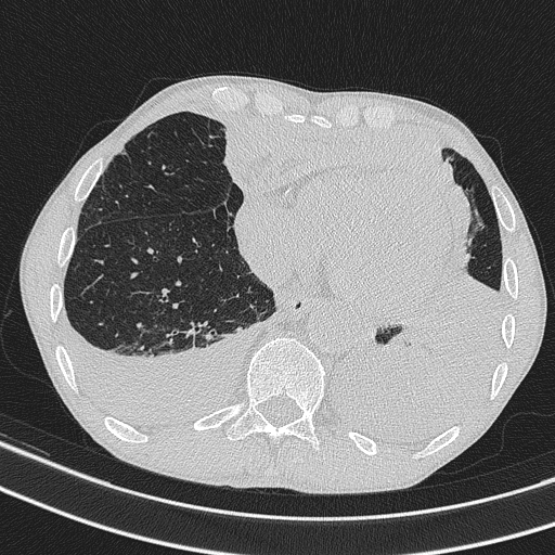 Central venous catheter tip extravasation (Radiopaedia 82828-97113 Axial lung window 64).jpg