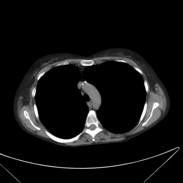 Centrilobular pulmonary emphysema (Radiopaedia 24495-24789 Axial non-contrast 16).jpg