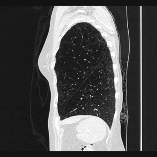 Centrilobular pulmonary emphysema (Radiopaedia 24495-24789 Sagittal lung window 73).jpg