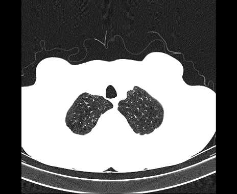 Centrilobular pulmonary emphysema (Radiopaedia 62468-70718 Axial lung window 7).jpg