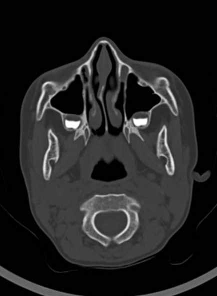 Cerebellar abscess (Radiopaedia 73727-84527 Axial bone window 13).jpg