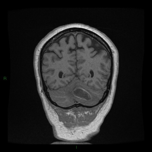 Cerebellar abscess (Radiopaedia 78135-90678 Coronal T1 C+ 130).jpg
