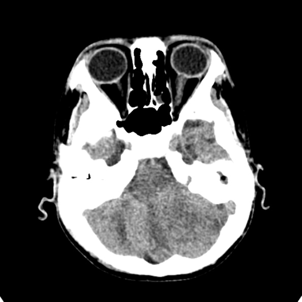 Cerebellar abscess secondary to mastoiditis (Radiopaedia 26284-26412 Axial non-contrast 34).jpg