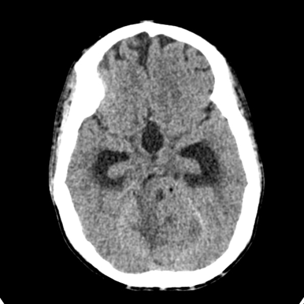 Cerebellar abscess secondary to mastoiditis (Radiopaedia 26284-26412 Axial non-contrast 59).jpg