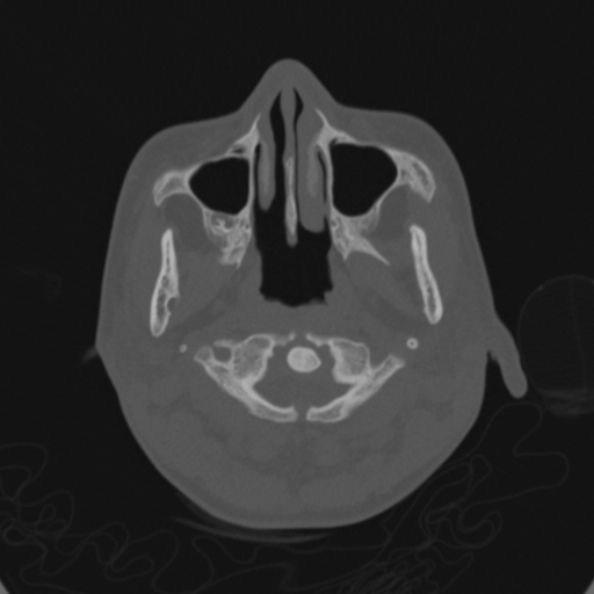 File:Cerebellar abscess secondary to mastoiditis (Radiopaedia 26284-26413 Axial bone window 1).jpg