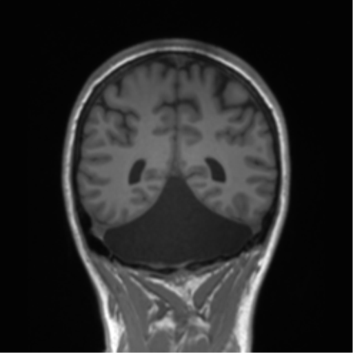 Cerebellar agenesis with hypoplastic pons (pontocerebellar hypoplasia) (Radiopaedia 57224-64138 Coronal T1 30).png