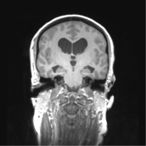 File:Cerebellar ependymoma complicated by post-operative subdural hematoma (Radiopaedia 83322-97736 Coronal T1 28).png