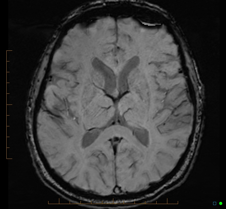 Cerebellar gangliocytoma (Radiopaedia 65377-74422 Axial SWI 31).jpg