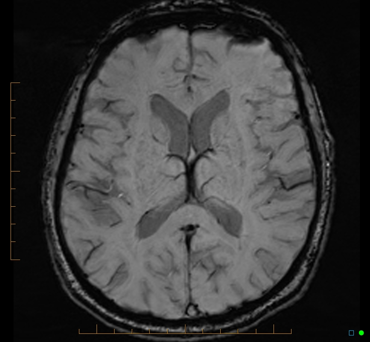 Cerebellar gangliocytoma (Radiopaedia 65377-74422 Axial SWI 32).jpg
