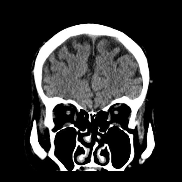 Cerebellar hemorrhage (Radiopaedia 27193-27359 Coronal non-contrast 15).jpg