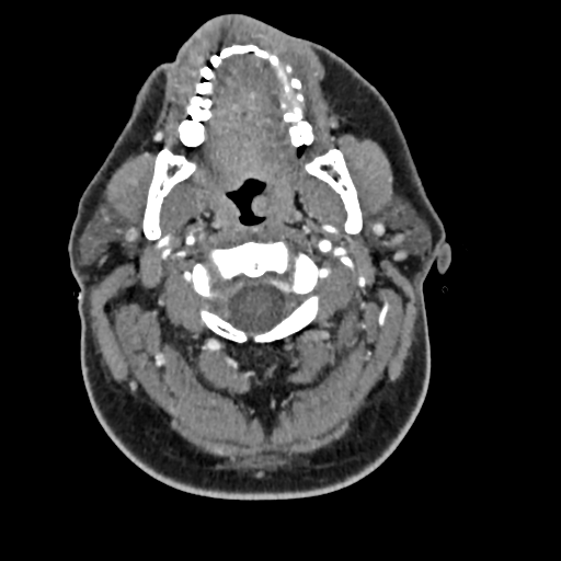 Cerebellar infarct due to vertebral artery dissection with posterior fossa decompression (Radiopaedia 82779-97029 C 68).png