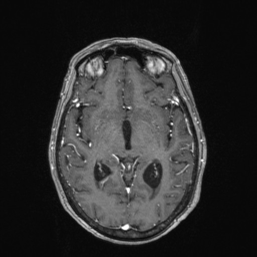 Cerebellar metastases (Radiopaedia 24038-24249 Axial T1 C+ 17).jpg