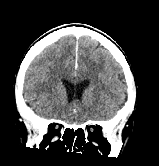 Cerebellar metastases - colorectal adenocarcinoma (Radiopaedia 40947-43652 Coronal C+ 33).png