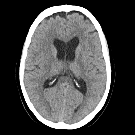 Cerebellar metastasis (Radiopaedia 54578-60812 Axial non-contrast 27).png