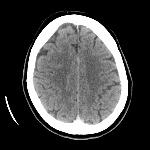 File:Cerebellar metastasis (cystic appearance) (Radiopaedia 41395-44258 B 37).png