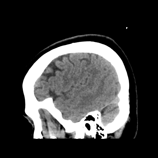 Cerebellar metastasis (cystic appearance) (Radiopaedia 41395-44258 E 14).png